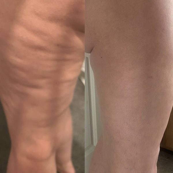 Dr C Tuna Flaunt It Anti Cellulite Gel and Scrub Package - Image 4